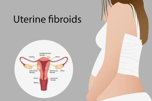 Endometriosis The female reproductive system in normal conditions and in cases of uterine pain vector