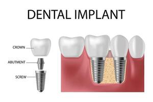Placement of a titanium implant into the jawbone to replace a missing tooth. vector