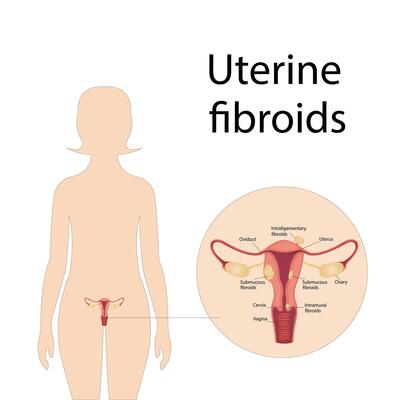 Schematic illustration of the uterus, diseases of the female reproductive system
