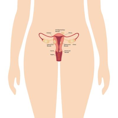 Location of uterine fibroids. Schematic illustration of the uterus, diseases of the female reproductive system