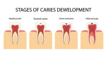 Development of caries. Stages of dental vector