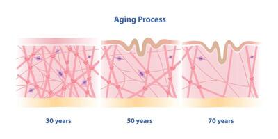 Cross section of aging process skin comparison illustration isolated on white background. High density, depletion and low density of collagen, elastin fibers and fibroblasts in the dermis. vector