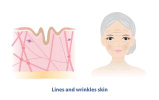 The old woman with lines and wrinkles skin on white background. Cross section of low density of collagen, elastin fibers and fibroblasts in the dermis layer. Skin care and beauty concept. vector