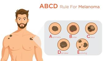 ABCD Rule for Melanoma Identifying Asymmetry, Border, Color, and Diameter Changes vector