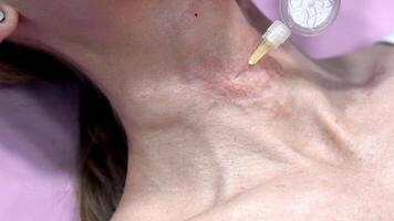 Doctor giving an injection of carbon dioxide therapy or carboxytherapy to her patient in an aesthetic clinic. video