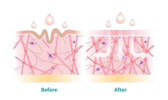 Before and after the skincare rejuvenate collagen and elastin in dermis illustration on white background. Cross section of wrinkles skin and skincare absorbing to help restore aging skin. vector