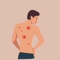 man with skin sores on his back, representing symptoms of skin conditions or infectious diseases. Flat design, suitable for healthcare, medical, and dermatology concepts vector