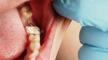 Close up on suture after gum surgery. The molar was extracted and the wound was closed with stitches and adjacent tooth was filled with temporary filling material for root canal treatment. Dental care photo