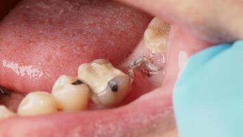Close up on suture after gum surgery. The molar was extracted and the wound was closed with stitches and adjacent tooth was filled with temporary filling material for root canal treatment. Dental care photo