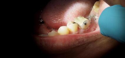 Close up on suture after gum surgery. The molar was extracted and the wound was closed with stitches and adjacent tooth was filled with temporary filling material for root canal treatment. Dental care photo