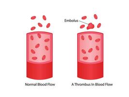 Thromboembolism. Normal blood flow and a thrombus in blood flow vector