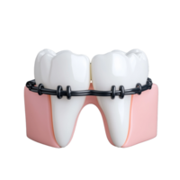 Orthodontic model showing two teeth with braces on pink gums on transparent background png