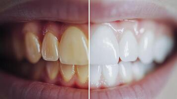 Discover how professional teeth whitening creates transformative appearance differences, showcasing impressive before and after results that lead to a brighter smile and increased confidence photo