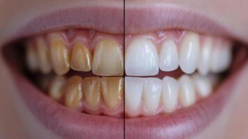 This remarkable transformation highlights the impressive and stunning results of teeth whitening procedures, showcasing the striking and noticeable differences in smiles before and after treatment photo