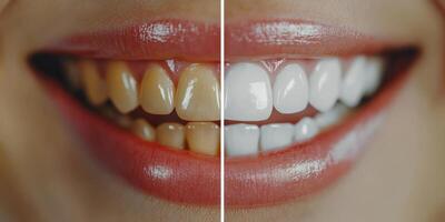 Take a look at the extraordinary transformation in teeth whitening displayed in this impressive before and after photo. Achieving a brighter and healthier smile is sure to leave a lasting impression photo