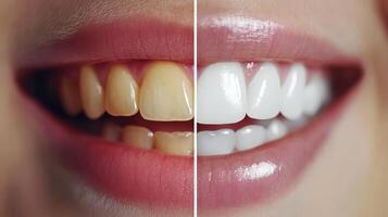 Witness the astonishing transformation of an individuals smile after a professional teeth whitening treatment, highlighting the significant differences seen before and after the procedure photo