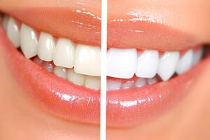 Explore the impressive and transformative results of teeth whitening treatments, showcasing the dramatic improvements in both smile brightness and overall confidence pre and posttreatment outcomes photo