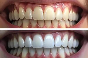 Experience a stunning transformation in teeth whitening results that showcases amazing before and after treatment images demonstrating effectiveness. Brighten your beautiful smile effectively now photo