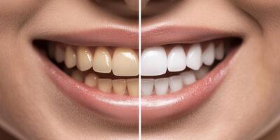 This image showcases a womans radiant smile before and after teeth whitening, highlighting a remarkable improvement in the color and brightness of her teeth, making the transformation impressive photo