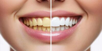 The image highlights the contrast in tooth color, showing the transformation before and after professional whitening, emphasizing the brighter smile that boosts confidence and beauty photo