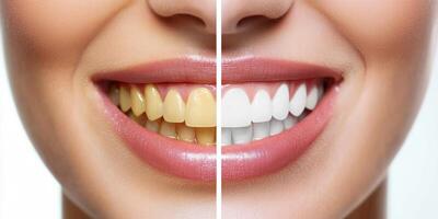 The image shows a striking teeth whitening contrast a yellowish smile on the left and a bright, white smile on the right, highlighting a transformation that conveys confidence and health photo
