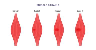 Muscle strain grading science diagram vector