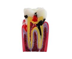 Dental implant, artificial tooth roots into jaw isolated on whtie backgroud with clipping path. photo