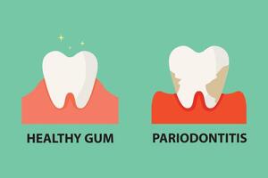 Stomatological concept. Comparison between healthy tooth and periodontitis tooth. vector