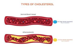 Understanding LDL, HDL, and Triglycerides and Their Impact on Heart Health vector