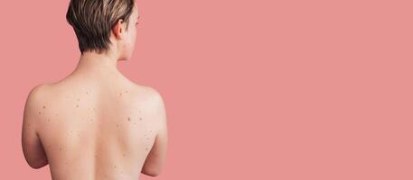 The back of a young woman with moles on the background. Without filters. Panoramic banner. A place for the text. photo