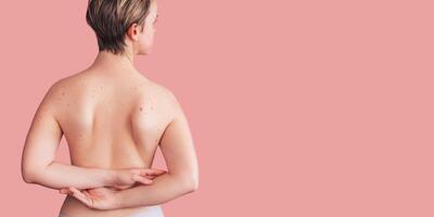 A woman's back with numerous moles. The effect of the sun on the skin. Skin cancer. The panorama. A place for the text. photo