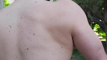 Back View Of A Boy With Many Moles On His Back video