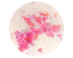 Paps smear analysis, Superficial squamous cell, metaplastic squamous cell, koilocytes cell. HPV related change photo
