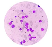 Bone marrow study, Suggestive of reactive marrow with dimorphic Erythroid hyperplasia photo