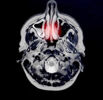 Magnetic resonance imaging of a patient with bad nose breathing, nasal congestion. The concept of hyperplasia of the ethmoid cell mucosa, otolaryngology photo