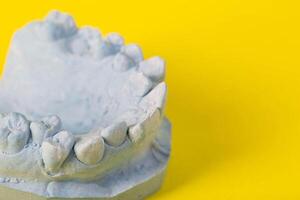 Blue plaster model of an impression of a patient's jaw at an orthodontist dentist on a yellow background. Manufacturing of dentures and crowns for dental prosthetics in orthodontics, macro. photo