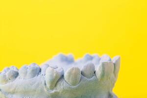 Blue plaster model of an impression of a patient's jaw at an orthodontist dentist on a yellow background. Manufacturing of dentures and crowns for dental prosthetics in orthodontics, macro. photo