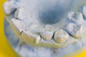 Blue plaster model of an impression of a patient s jaw at an orthodontist s dentist, close-up. Crooked teeth, correction of malocclusion, macro photo