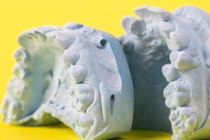 Blue plaster impression of a patient's dental jaw with crooked teeth and malocclusions on a yellow background. Manufacturing of bridges, crowns of various types, macro, arrangement of teeth photo
