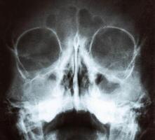 X-ray image of the skull of a child with purulent sinusitis, close-up. Treatment of inflamed sinuses, purulent secretion photo