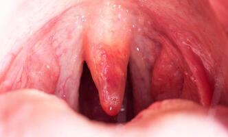 Red, inflamed and swollen uvula in the throat. Treatment of uvulitis due to bacteria and streptococcal viruses. Otolaryngology, macro. Allergy photo