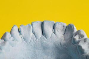 Blue plaster impression of a patient's dental jaw with crooked teeth and malocclusions on a yellow background. Manufacturing of braces to correct bite. View from above. Copy space for text photo