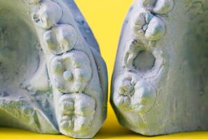 Blue plaster impression of a patient's dental jaw with crooked teeth and malocclusions on a yellow background. Manufacturing of bridges, crowns of various types, macro, arrangement of teeth photo