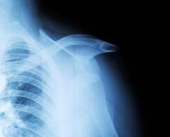 X-ray of a fractured humeral head and shoulder dislocation. Clavicle fracture. Traumatology and orthopedics., close-up photo
