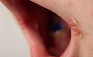 Seizures on the corners of the lips of a child s mouth. Bacterial disease of inflammation of the corners of the lips. Angular stomatitis with reduced immunity in a child, macro photo