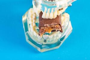A bitten piece of chocolate in a dental jaw mockup on a blue background. The concept of the effect of sugar and leftover food on teeth and tooth enamel. photo