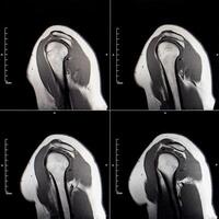 MRI image of the shoulder joint after dislocation. Impression fracture of the humeral head. Shoulder injury, close-up photo