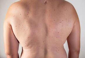 Red pimples on a man's back. Skin irritation and allergy concept. Diseases of the gastrointestinal tract, close-up photo