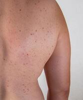 Red pimples on a man's back. Hormonal imbalance and increased testosterone, close-up photo
