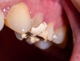 Installation of a temporary filling in the treatment of tooth canals, endodontics. Tooth pulpitis in dentistry, macro photo